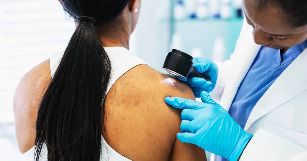 Cinq signes cruciaux indiquant que votre grain de beauté pourrait être un mélanome, explique l'oncologue au Dr Hilary