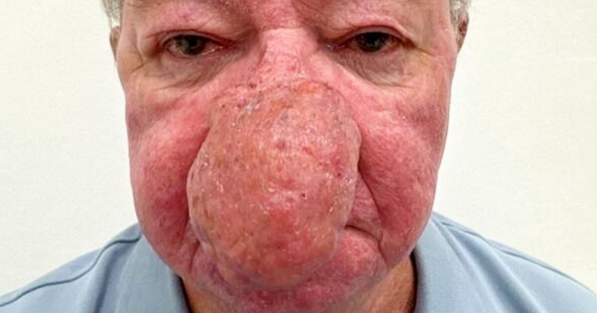 'I couldn't kiss my wife because my nose just kept growing'