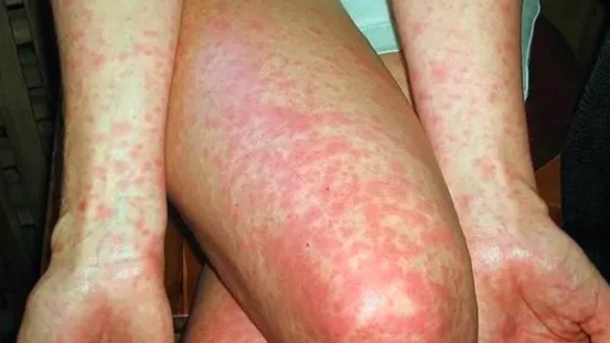 Advertencia urgente: el estado australiano registra el sexto caso de enfermedad mortal este año