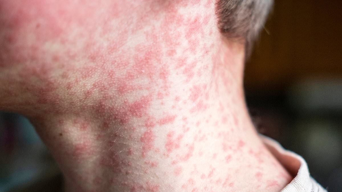 Cases of the world's most infectious disease keep climbing in the UK - with two major areas most at risk
