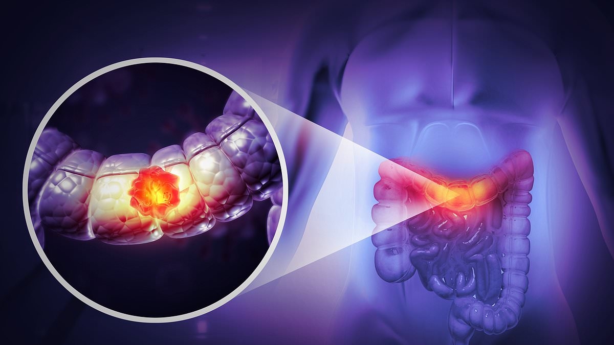 Top doctor reveals simple DIY method that can show if your bowel movements are healthy - as digestion issue is linked to colon cancer