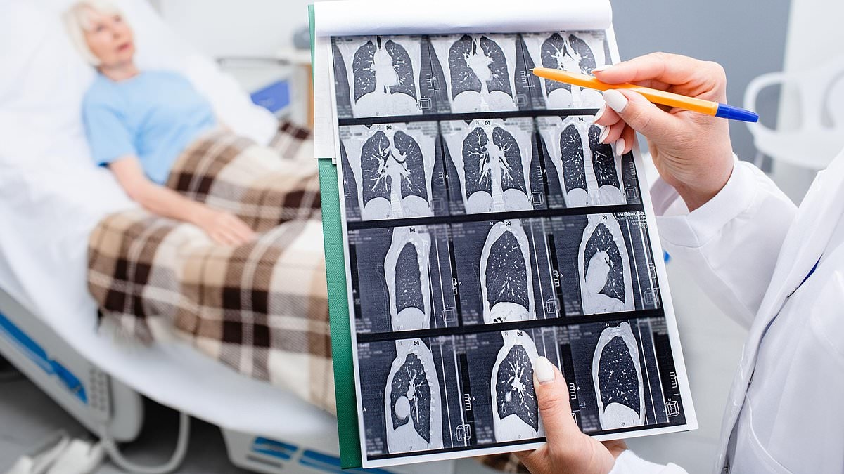 'I was in incredible pain... the doctor said it was just discomfort from breastfeeding': Gini was a non-smoker whose bad shoulder left her in agony. Eventually, she discovered it was lung cancer. Now, our expert reveals the hidden signs of the disease