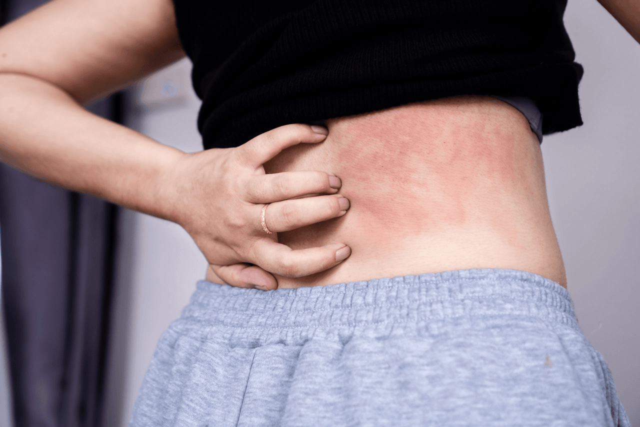 Quels sont les meilleurs traitements contre l’urticaire chronique ?