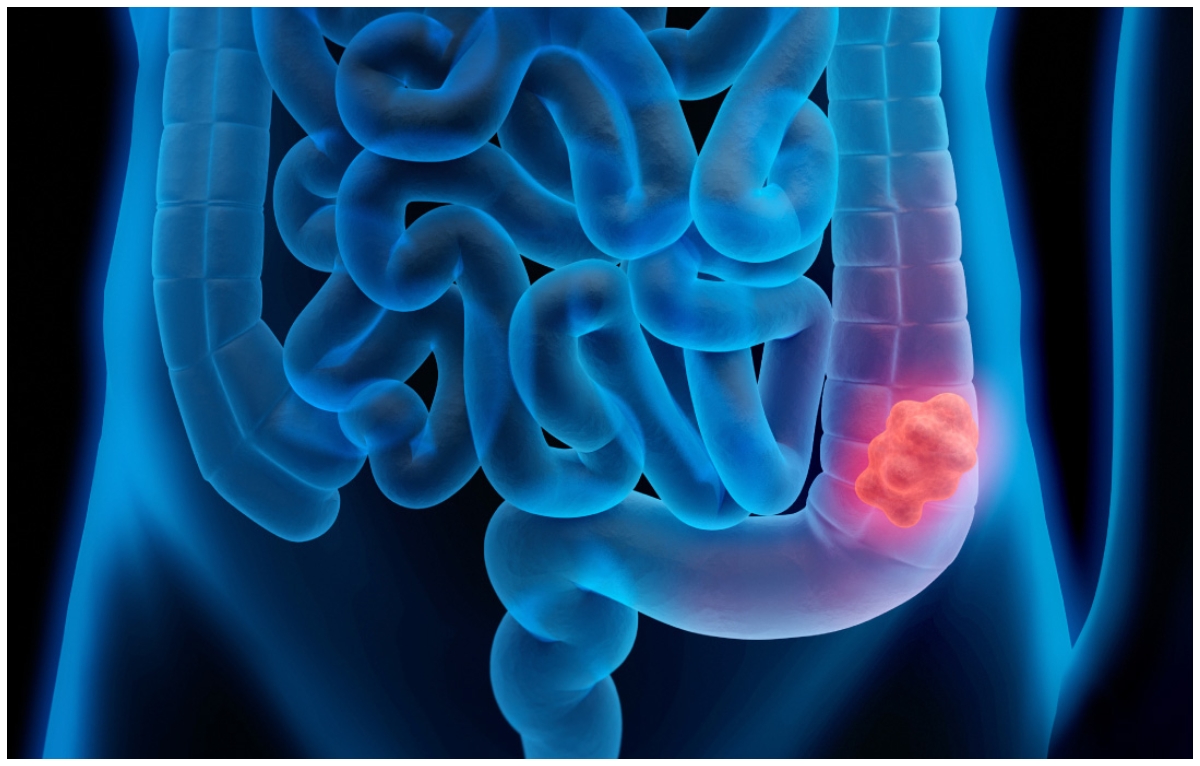 Dimmi cosa mangi e ti dirò qual è il tuo rischio di cancro del colon-retto.