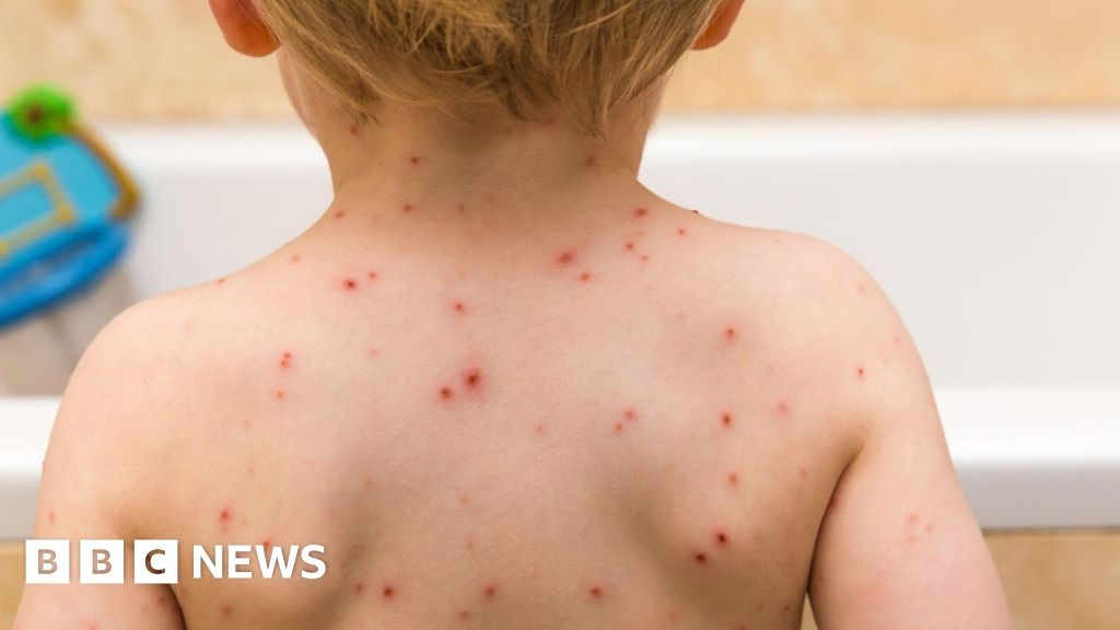 Children to be offered chickenpox vaccine on NHS