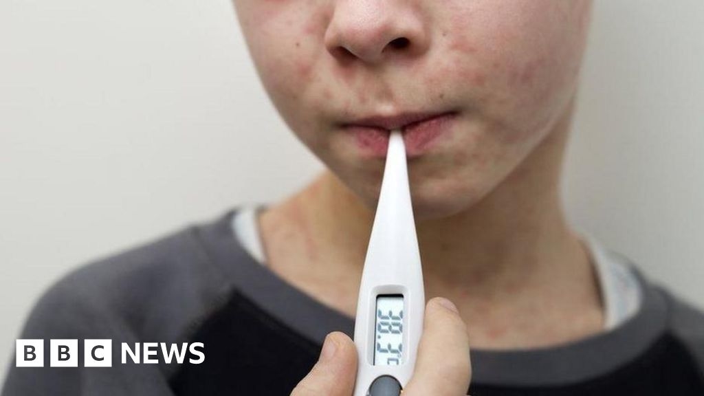 Perché i casi di morbillo sono in aumento nel Regno Unito?