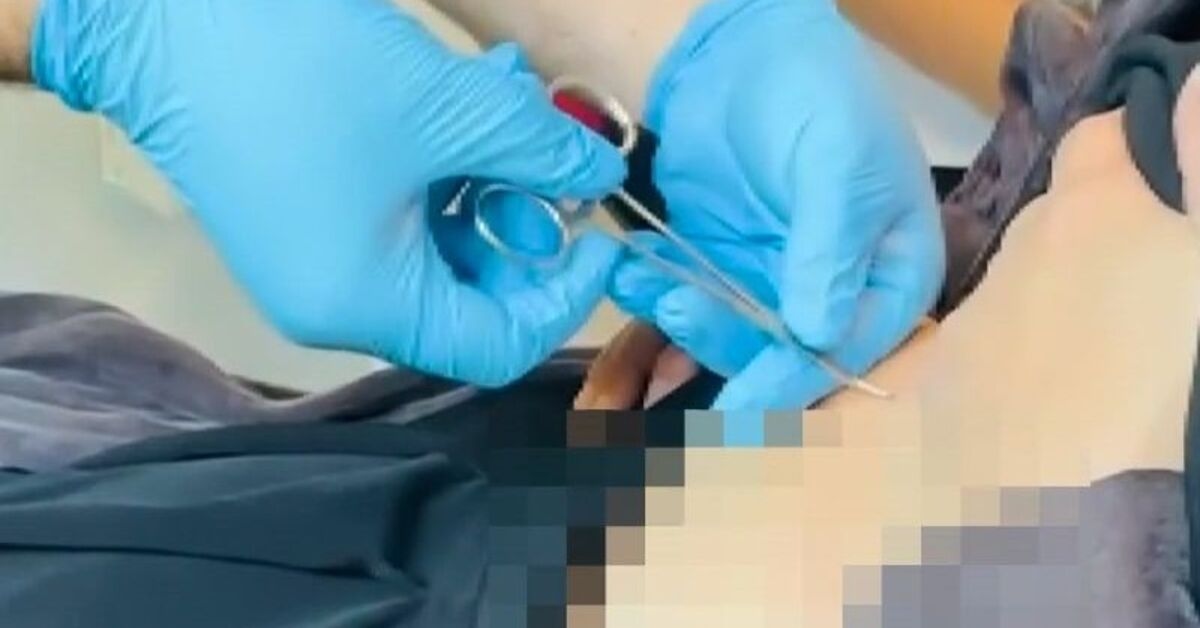 Er ging ins Krankenhaus und klagte über Schwäche! Eine Zecke kam aus seinem Bauch