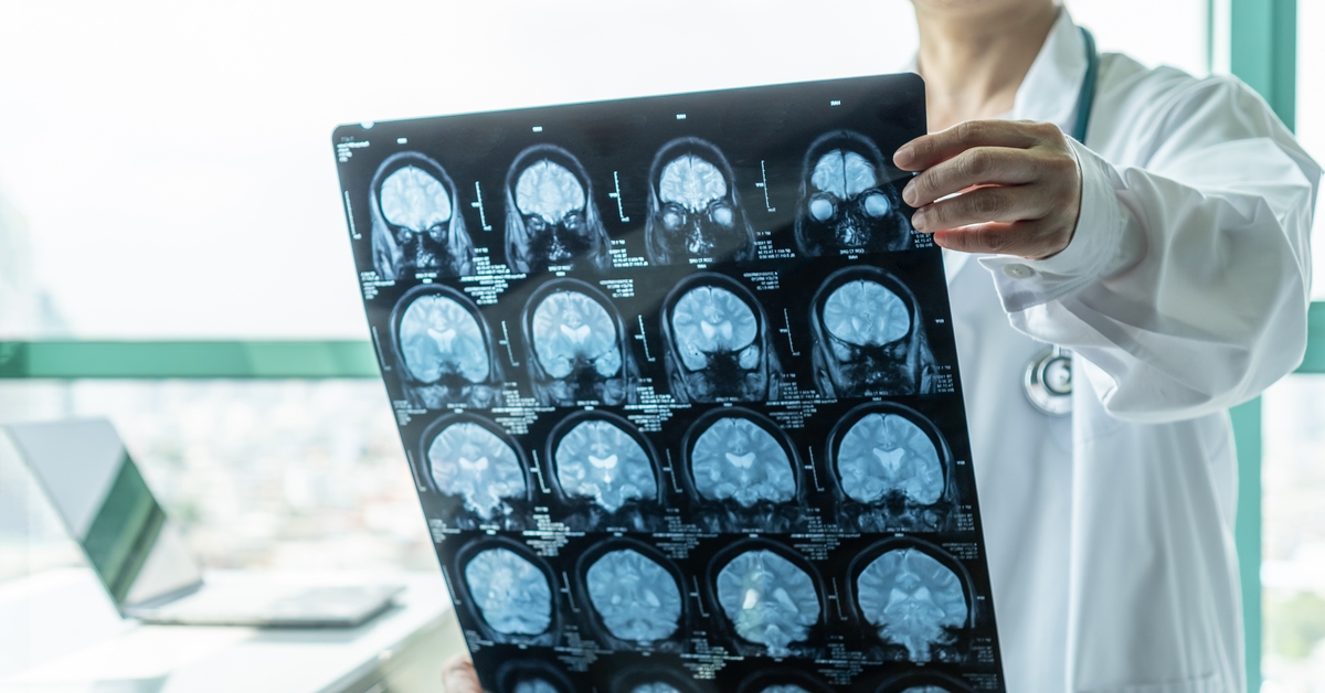 Watch out for midlife dementia!