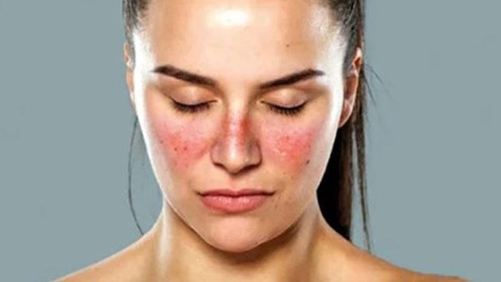 Flecken im Gesicht können ein Anzeichen für Lupus sein! Es kann viele Organe beeinträchtigen