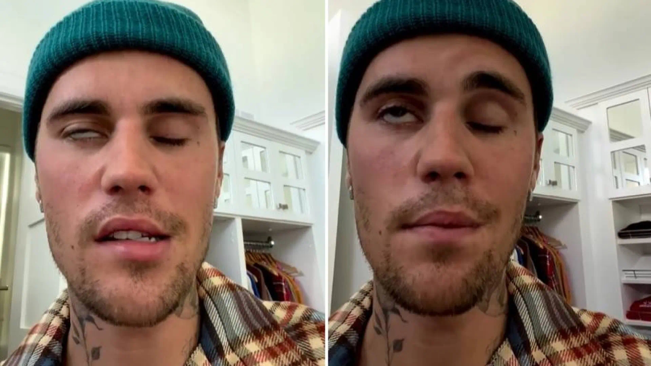 Justin Bieber'ın yüzünün yarısının felç olmasıyla oluşan hastalık olan Ramsay Hunt sendromu nedir?
