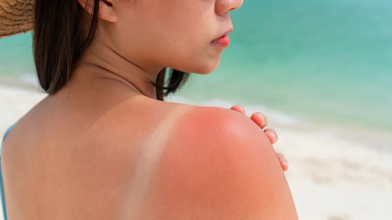 Pięć sposobów na szybsze gojenie się oparzeń słonecznych, według dermatologa