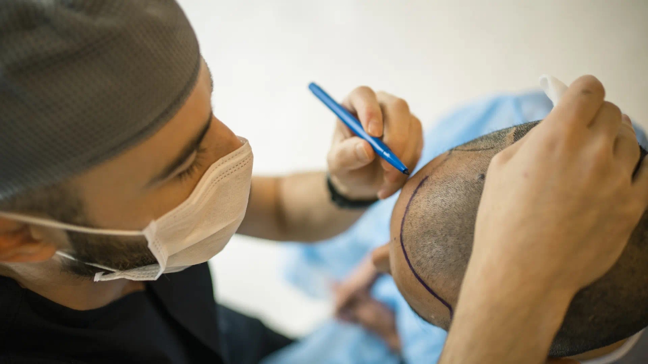 Muere un hombre tras realizarse un trasplante capilar: estos son los riesgos y efectos secundarios más comunes