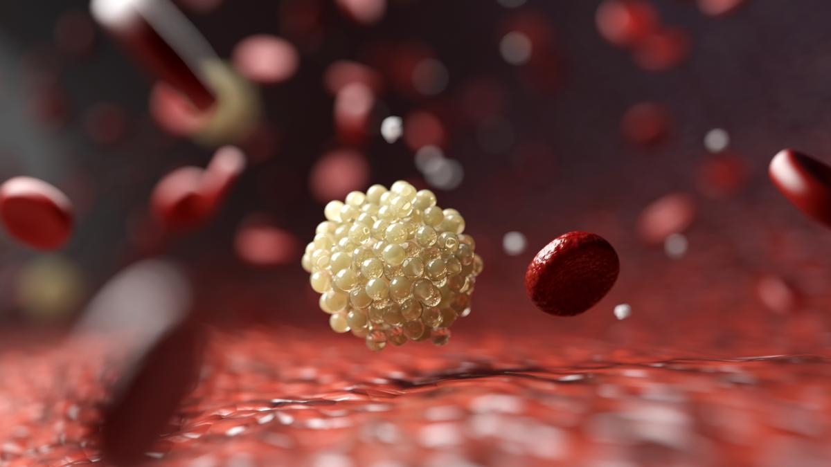 Onderzoekers zijn erin geslaagd om het 'slechte' cholesterol met bijna de helft te verlagen met behulp van een combinatietherapie met een nieuw medicijn.