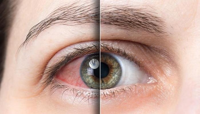 Unterschätzen Sie Ihre Augengesundheit nicht! Schluss mit Brennen und Stechen: „Trockene Augen mindern die Lebensqualität“