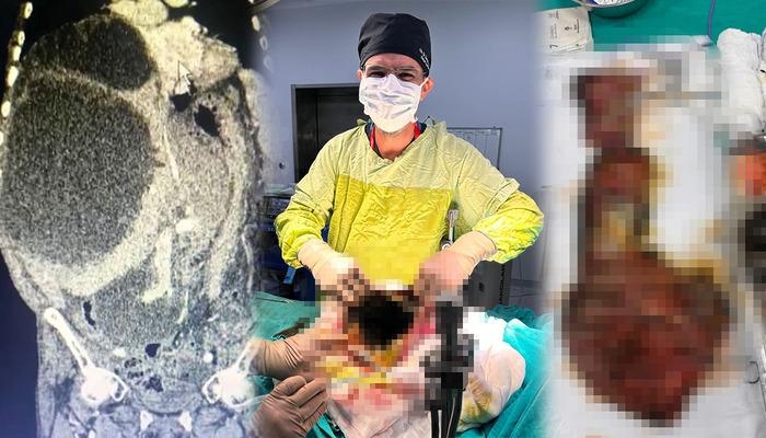 A case that entered world literature: The abdomen and liver were covered in cysts! The cat-dog cyst, which reached 90 centimeters, was removed! "It could have caused death."