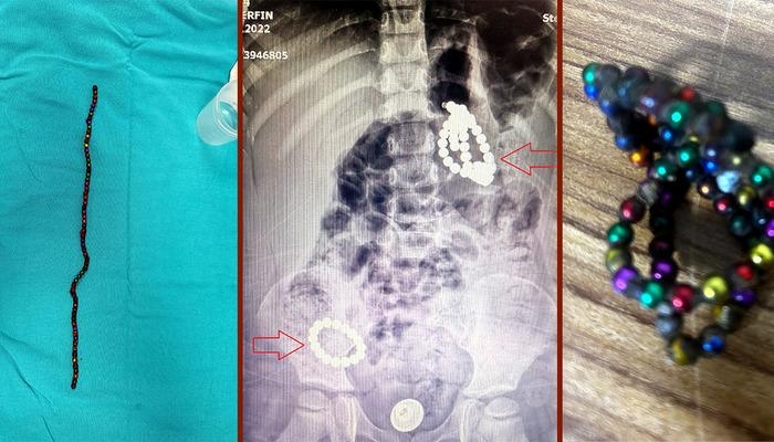 Bu oyuncak bir ölüm tuzağı! Herkesi çok şaşırtan vaka: 3 yaşında, karnında 66 adet mıknatısla aylarca yaşamış! Tehlikeye karşı uyarı: "İç organlarını deliyor"