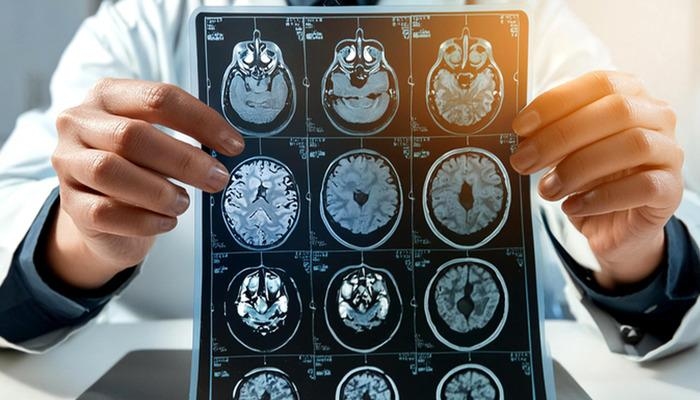 Beeindruckende neue Forschung aus Harvard: Neue Hoffnung für die Alzheimer-Behandlung! Experten: „Dies könnte ein wichtiger Wendepunkt sein“