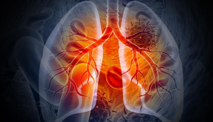 EE.UU. recortará ayuda exterior: ¡Más de 2 millones de personas podrían morir de tuberculosis!
