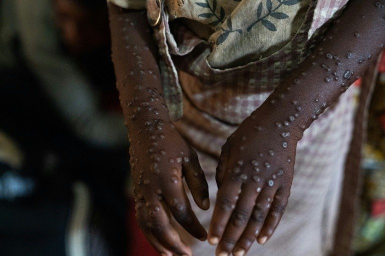 MPOX is no longer an international health emergency, announces WHO