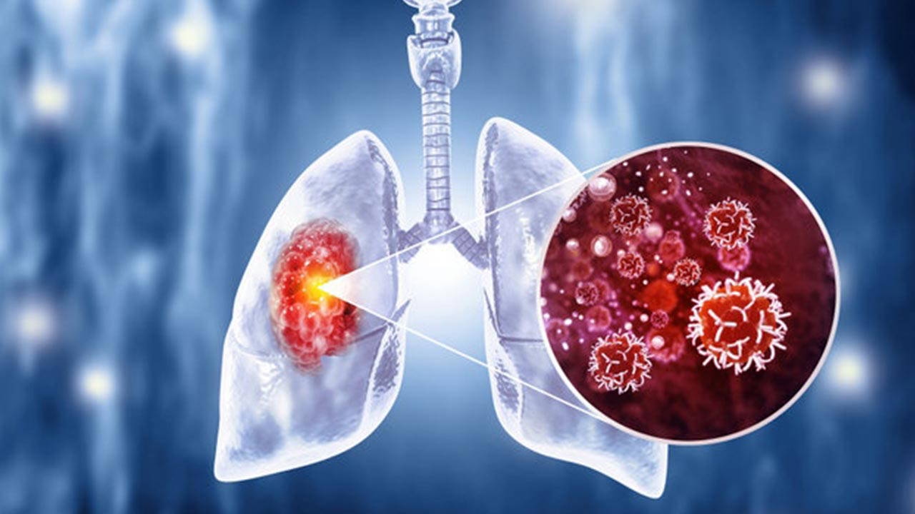 Experte warnte: „Ernährung beeinflusst die Immunität bei Lungenkrebs.“