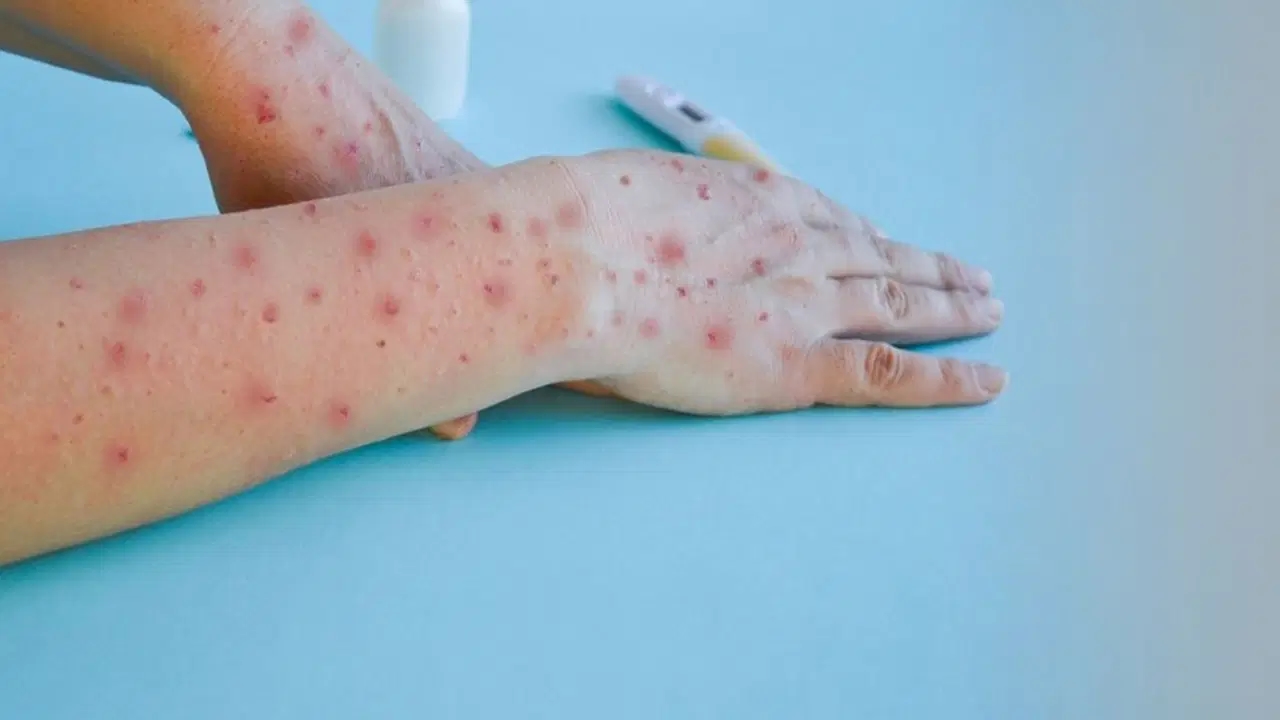 Experts warned: It spreads very quickly among children!