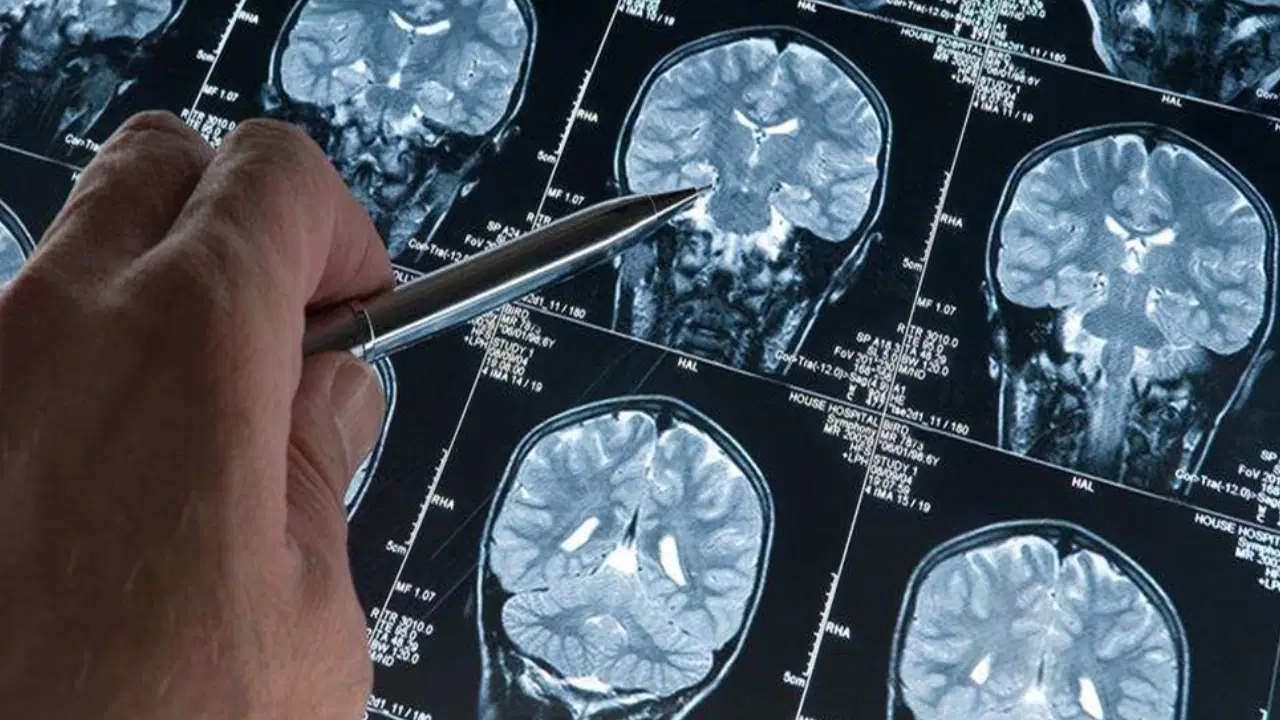 Ein neuer Schritt in der Frühdiagnose: Die „Bluttest“-Ära bei Alzheimer