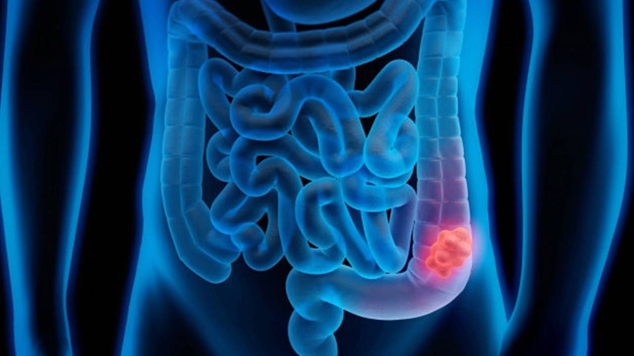 Aumento de casos de cáncer de colon: el diagnóstico temprano salva vidas