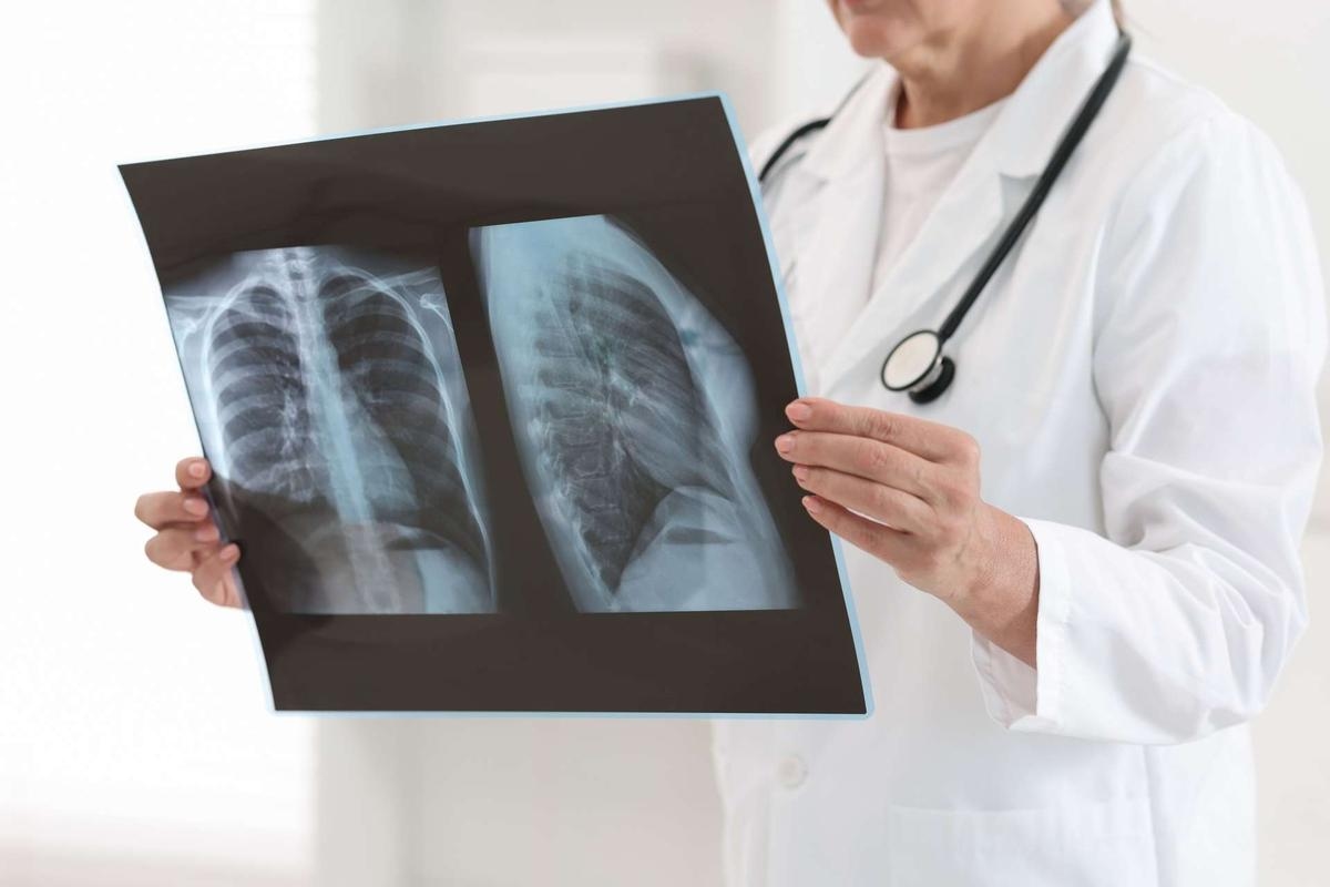 Lung adenocarcinoma: 3-year survival has doubled since 2000