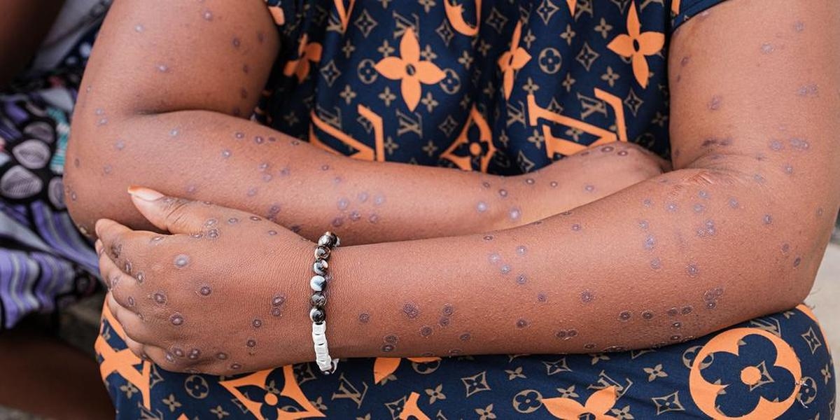 MPOX-geval vastgesteld in Senegal, Dakar neemt maatregelen om de ziekte te bestrijden