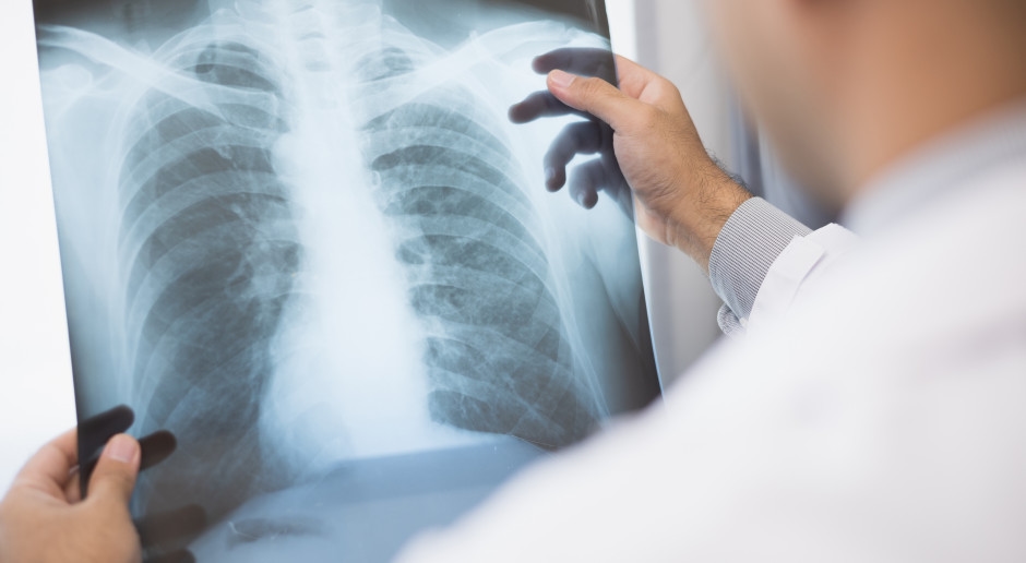 50% dos pacientes com câncer de pulmão têm mais de 70 anos