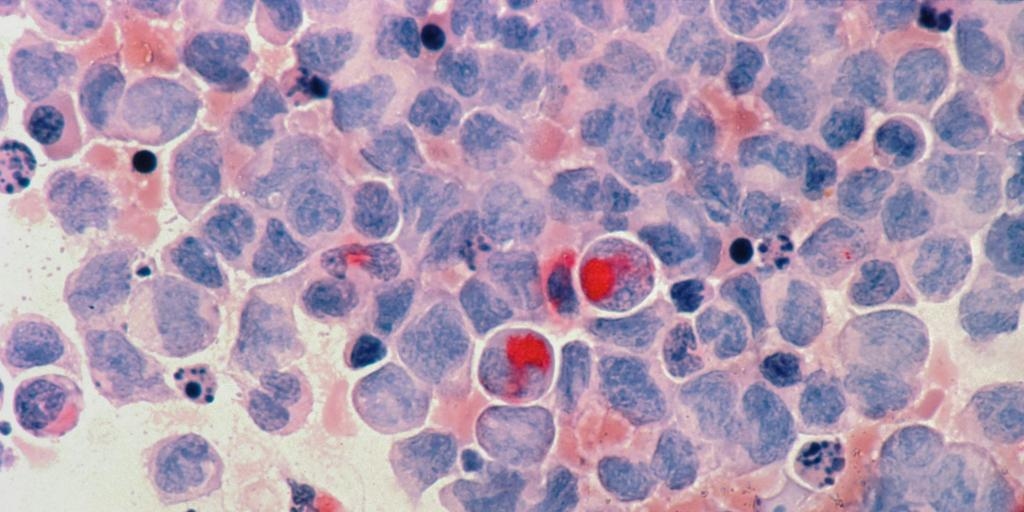 This is the 'forgotten' cancer that is increasing the most among young people.