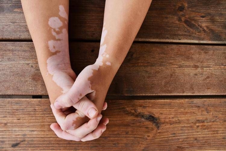 Yaz, vitiligo ve güneş: Güvenli bronzlaşma kuralları