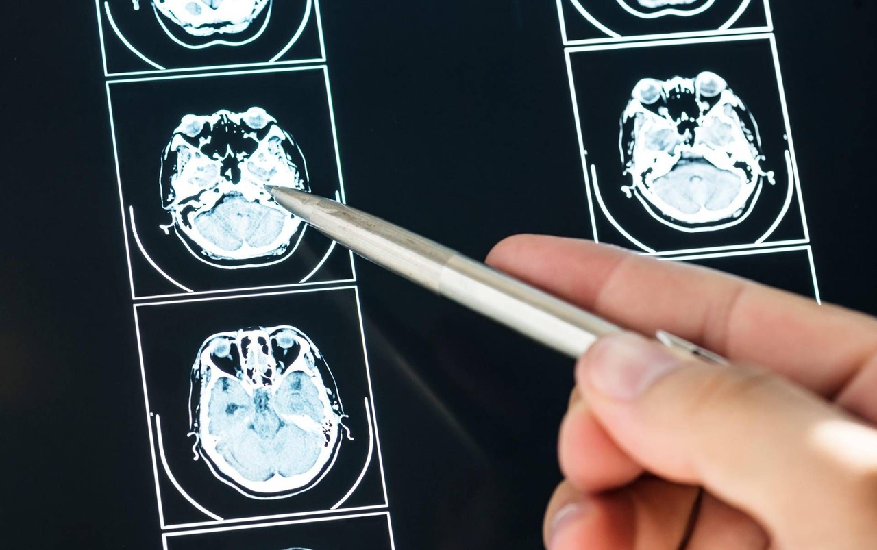 La inteligencia artificial puede predecir la evolución del Parkinson, según un estudio italiano