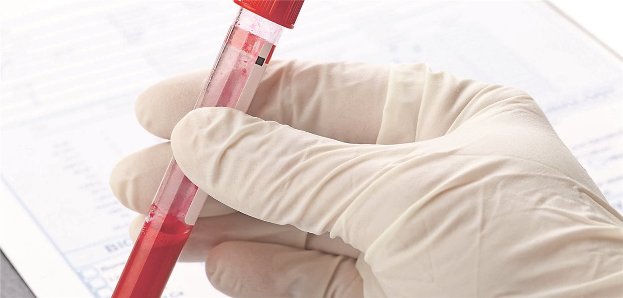 Novo medicamento hipolipemiante obicetrapib reduz o colesterol LDL e a lipoproteína(a)
