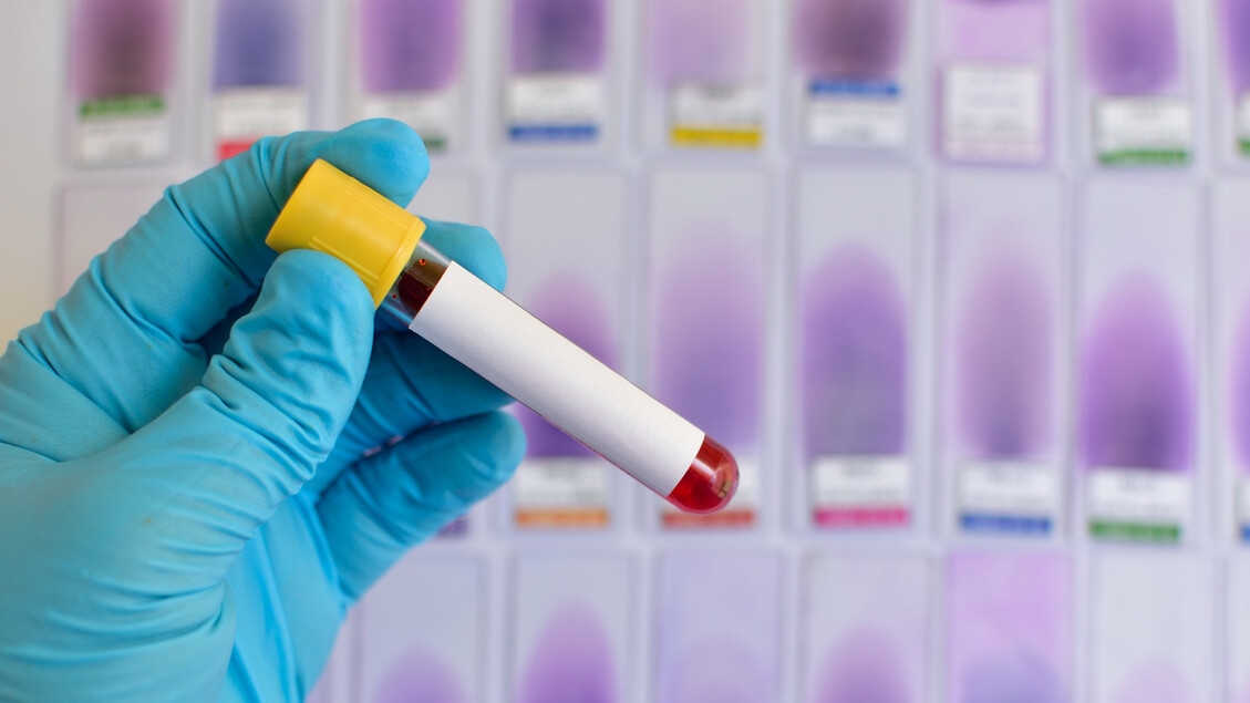 ISS announces a national plan against hepatitis and HIV