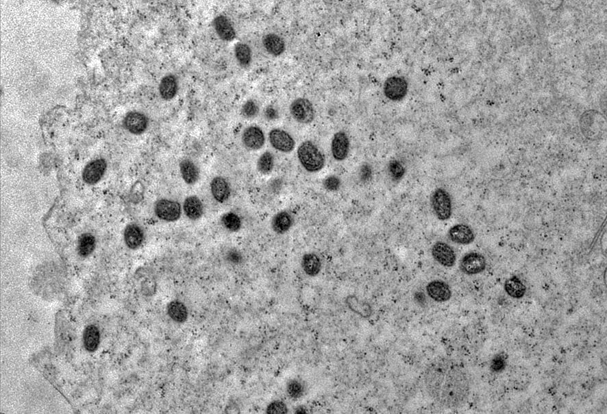 MPOX is no longer an international health emergency, announces WHO