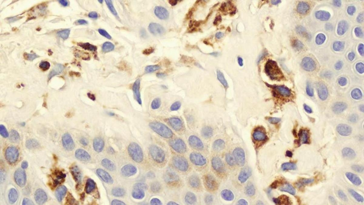 Mastocitose: Como reconhecer os sintomas e tratar esta doença rara