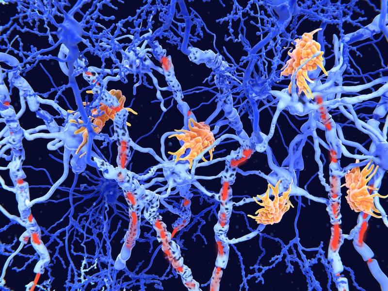 Sclérose en plaques : un biomarqueur identifie les patients susceptibles de bénéficier de l'acétate de glatiramère