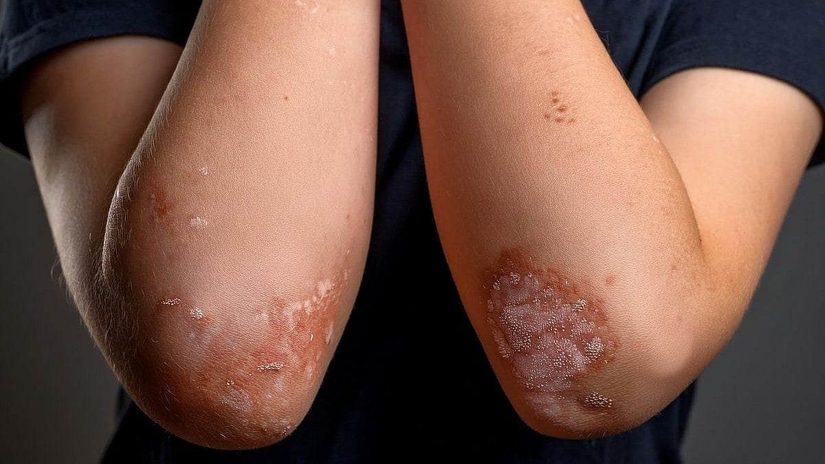 Divorce and separation may triple the risk of psoriasis in children.