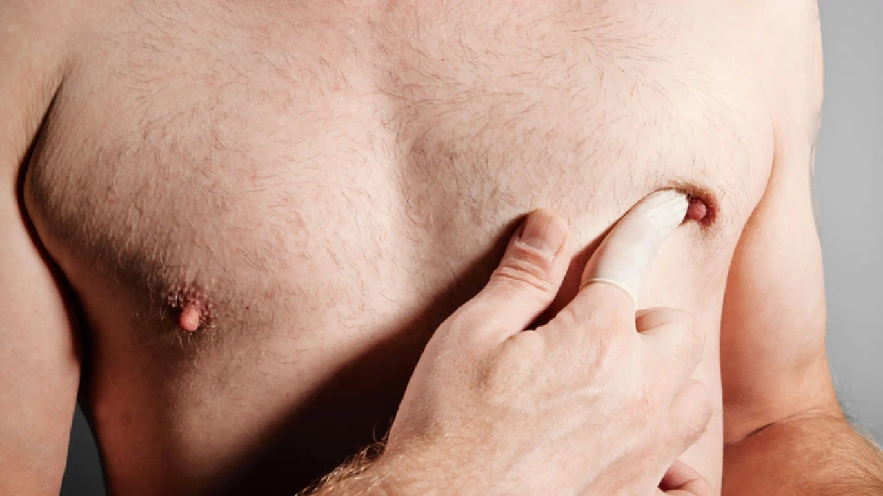 Men with breast cancer urge self-examination to avoid late diagnosis